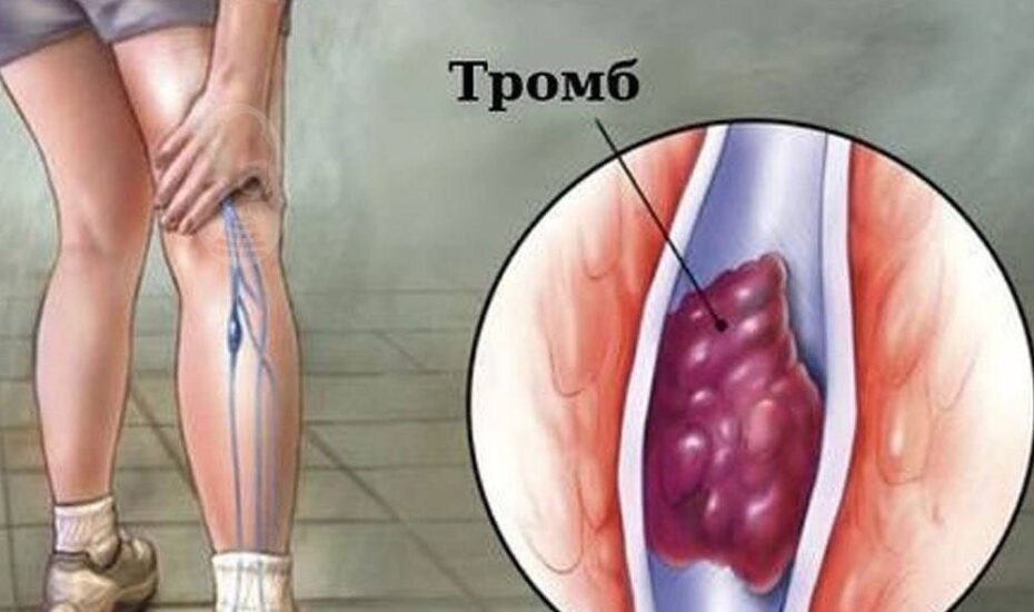 برای جلوگیری از لخته شدن خون چه باید کرد؟