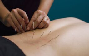 طب سوزنی تسکین کمردرد