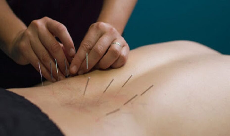 طب سوزنی تسکین کمردرد