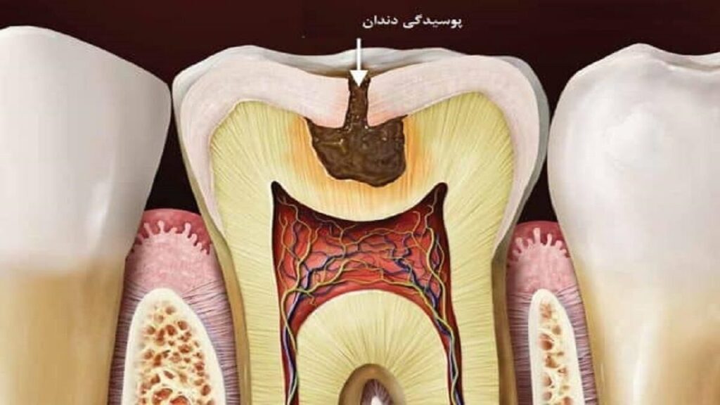 پوسیدگی دندان