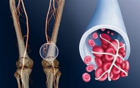۸ علامت خطرناک لخته شدن خون در بدن