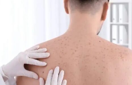چه افرادی نیاز به غربالگری سرطان پوست دارند؟ غربالگری سرطان پوست