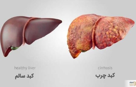 این نوشیدنی محبوب قاتل کبد چرب است کبد چرب