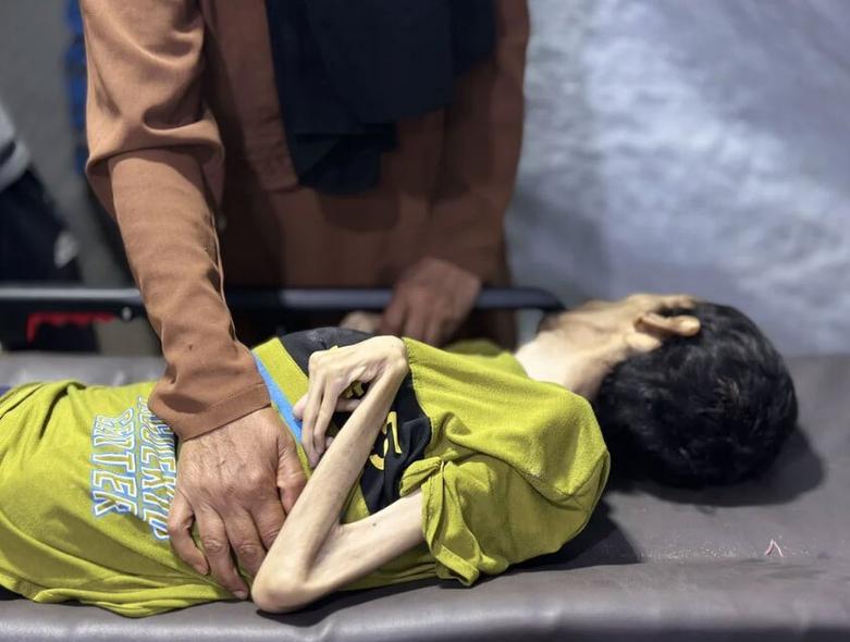 شهادت یک جوان فلسطینی 29 ساله در اثر سوء تغذیه 
