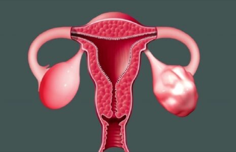 استروژن‌های گیاهی سندرم تخمدان پلی‌کیستیک