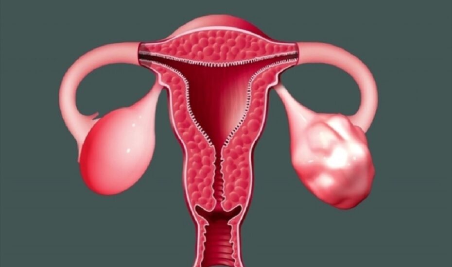استروژن‌های گیاهی سندرم تخمدان پلی‌کیستیک