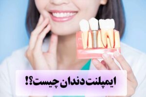 ایمپلنت چگونه است + لیست قیمت تهران ایمپلنت دندان چیست؟