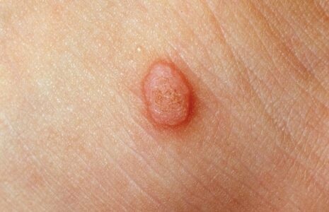 تفاوت خال گوشتی و زگیل؛ چرا کندن یا بستن نخ خطرناک است؟ تفاوت خال گوشتی و زگیل