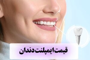 ایمپلنت چگونه است + لیست قیمت تهران