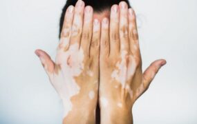 ویتیلیگو؛ بیماری پوستی غیرمسری