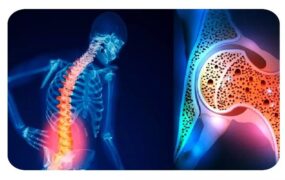 برنامه غذایی روزانه مبتلایان به استئوپنی