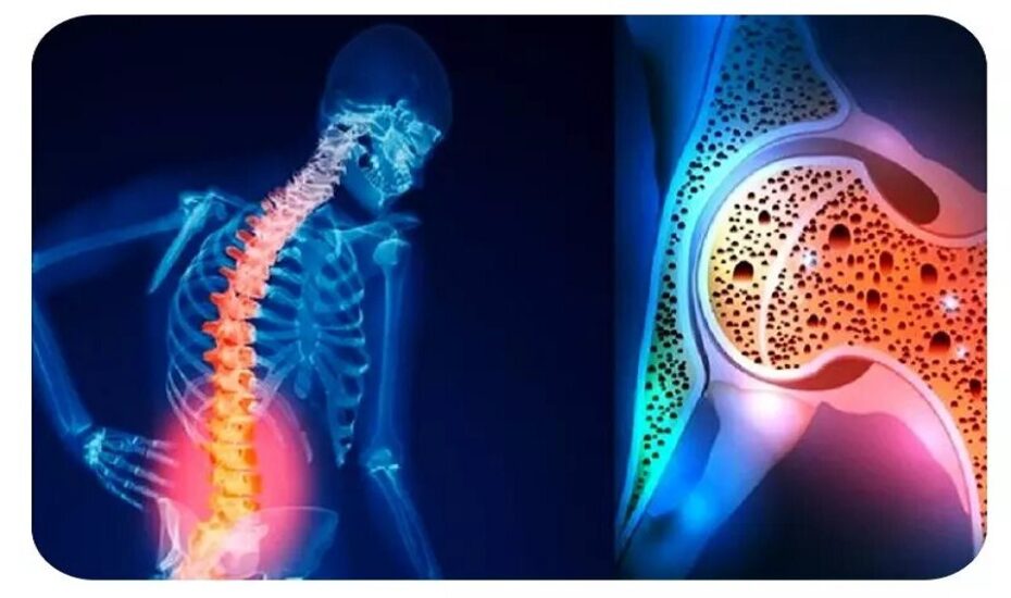 برنامه غذایی روزانه مبتلایان به استئوپنی