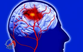 آمار باورنکردنی سکته مغزی در تهران سکته مغزی