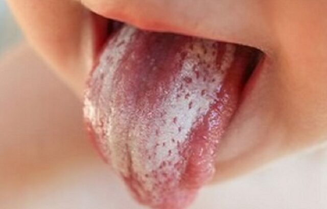 راهنمای والدین برای برفک دهانی در نوزادان/ اینفوگرافی