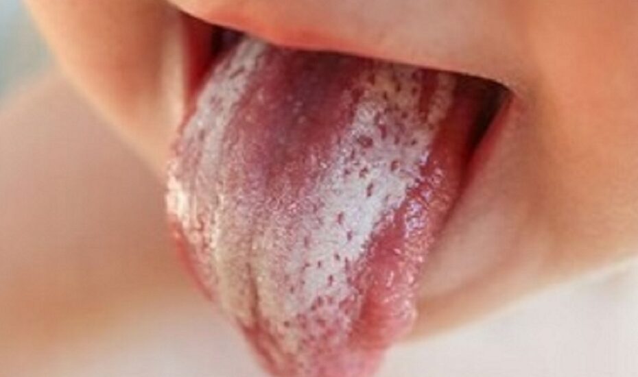 راهنمای والدین برای برفک دهانی در نوزادان/ اینفوگرافی