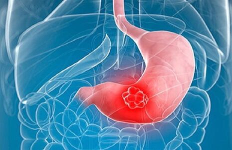 ۵ علامت پنهان سرطان معده که نباید نادیده بگیرید