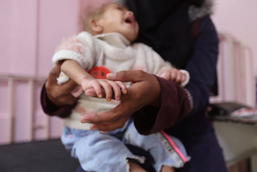 کودک فلسطینی با سوء تغذیه شدید در نوار غزه