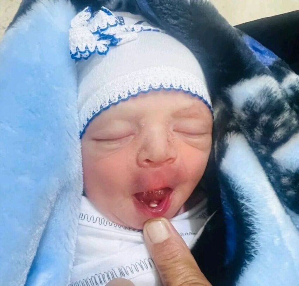 یک اتفاق نادر/ تولد نوزاد با دندان شیری/ عکس تولد نوزاد با دندان شیری