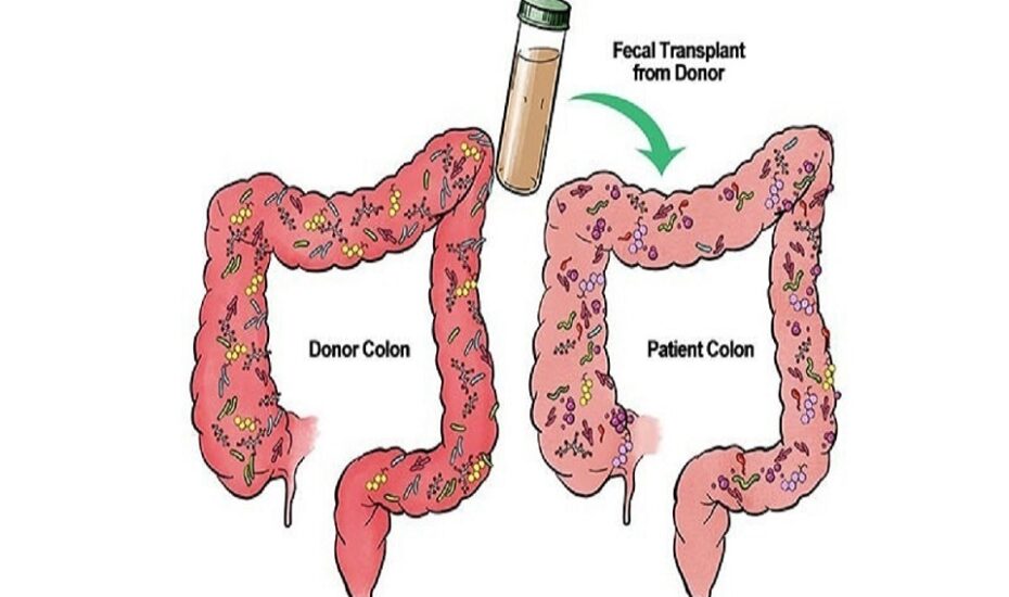 ایران در فهرست کشورهای پیشرفته درمان با پیوند مدفوع