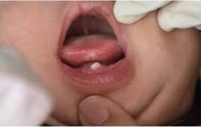 یک اتفاق نادر/ تولد نوزاد با دندان شیری/ عکس