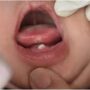یک اتفاق نادر/ تولد نوزاد با دندان شیری/ عکس