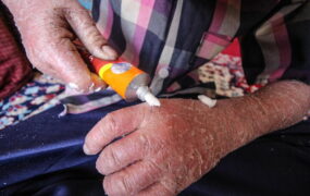 ماجرای تلخ رها شدن نوزاد پروانهای در بیمارستان تهران نوزاد پروانه ای