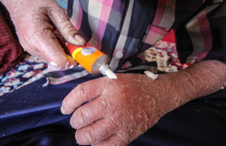 نوزاد پروانه ای