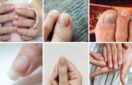 ۷ علامت ناخن کلسترول بالا