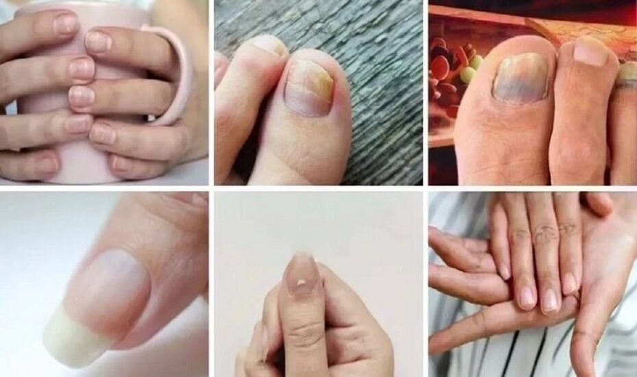 ۷ علامت ناخن کلسترول بالا