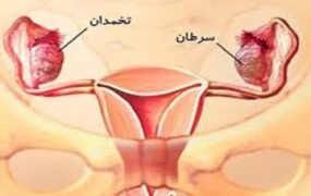 سرطان رحم پس از ۵۰ سالگی افزایش می‌یابد