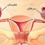 سرطان رحم پس از ۵۰ سالگی افزایش می‌یابد