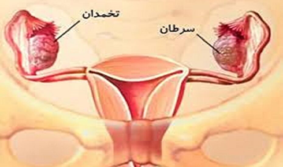 سرطان رحم پس از ۵۰ سالگی افزایش می‌یابد