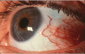 عفونت انگلی آکانتامبا؛ تهدید پنهان برای قرنیه و خطر نابینایی دائمی عفونت انگلی آکانتامبا