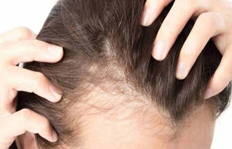 دلایل شایع ریزش مو