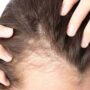 دلایل شایع ریزش مو