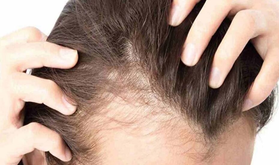 دلایل شایع ریزش مو