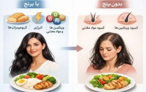 ریزش مو حذف برنج