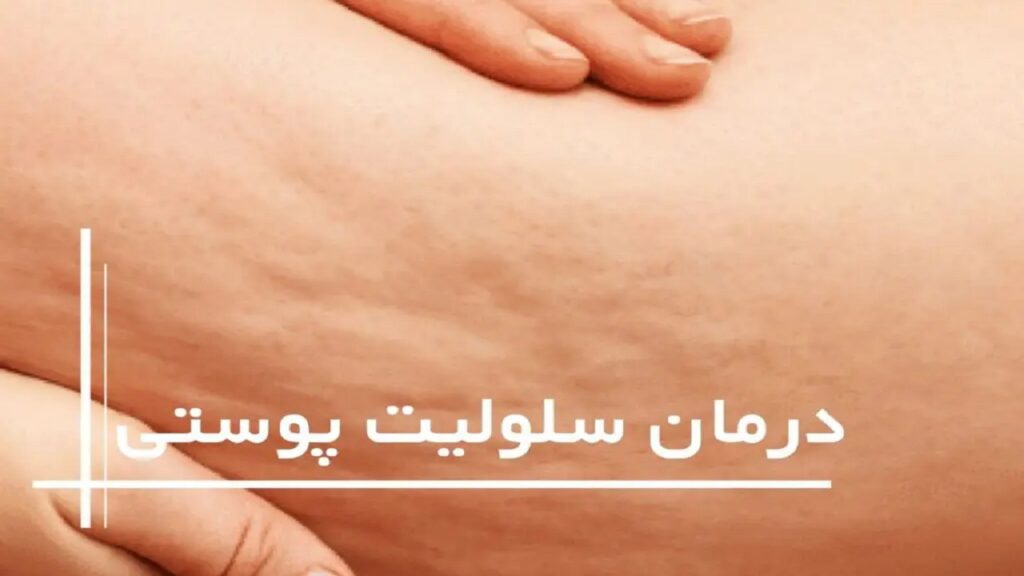 درمان خانگی سلولیت‌ها با ۵ روش ساده و طبیعی