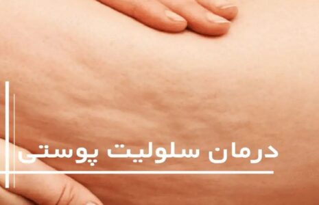 درمان خانگی سلولیت‌ها با ۵ روش ساده و طبیعی