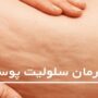 درمان خانگی سلولیت‌ها با ۵ روش ساده و طبیعی