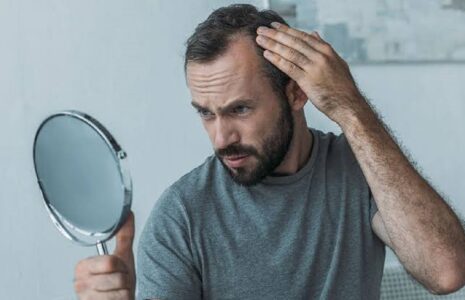 ریزش مو در مصرف‌کنندگان GLP-1 /عارضه جانبی نگران‌کننده داروهای لاغری