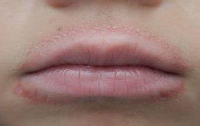 دلایل خشکی و التهاب اطراف دهان