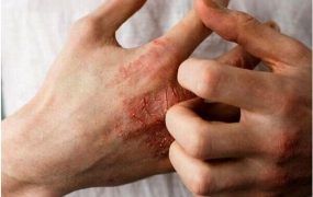 طاعون