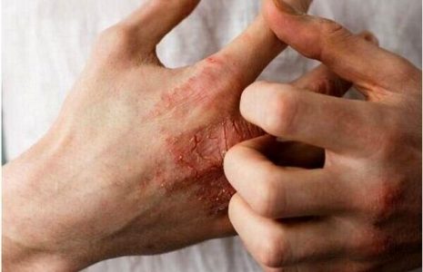 طاعون